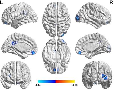 Changes in Resting-State Cerebral Activity in Women With Polycystic Ovary Syndrome: A Functional MR Imaging Study